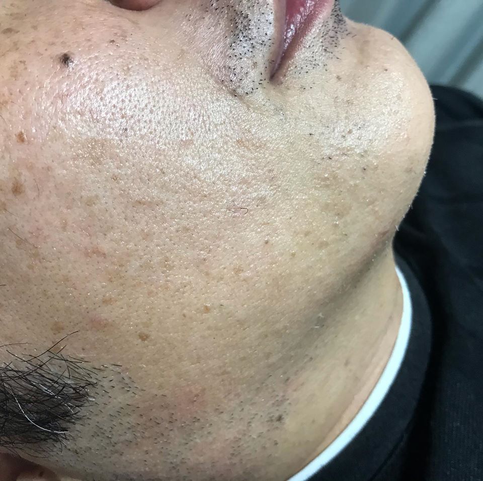 脱毛(フェイスライン)before