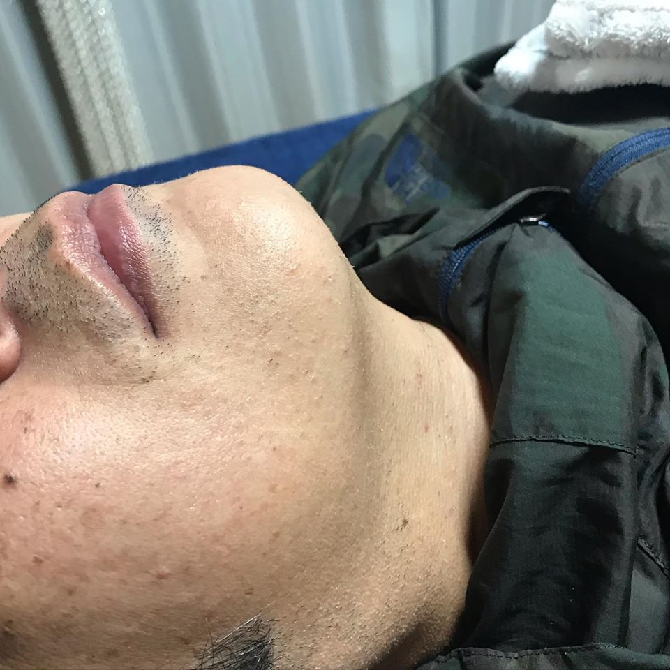 脱毛(フェイスライン)after