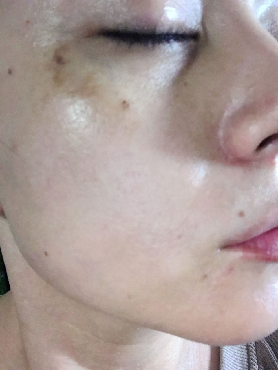 脱毛(フェイスライン)before