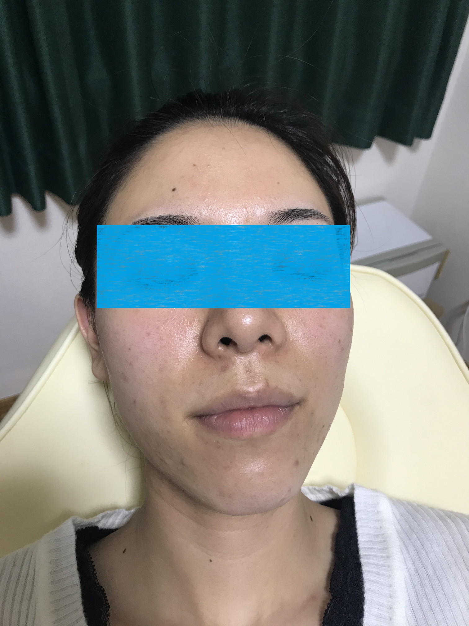 脱毛(フェイスライン)before
