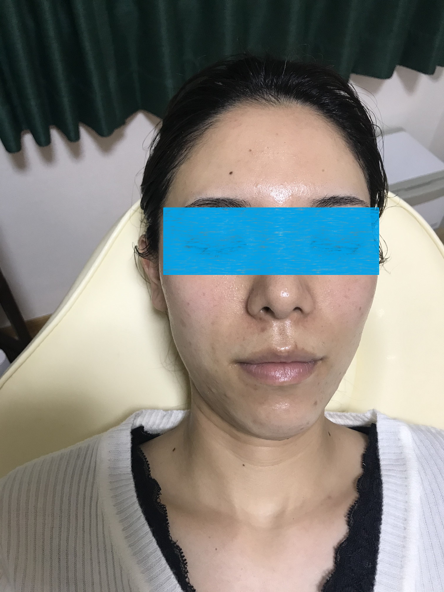 脱毛(フェイスライン)after